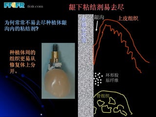 龈下粘结剂易去尽
                种   龈沟     上皮组织
为何常常不易去尽种植体龈
               植
沟内的粘结剂?         体
                表
                面

 种植体周的
 组织更易从
 修复体上分
 开。
                         环形胶
                         原纤维


                    骨组织



          *
 