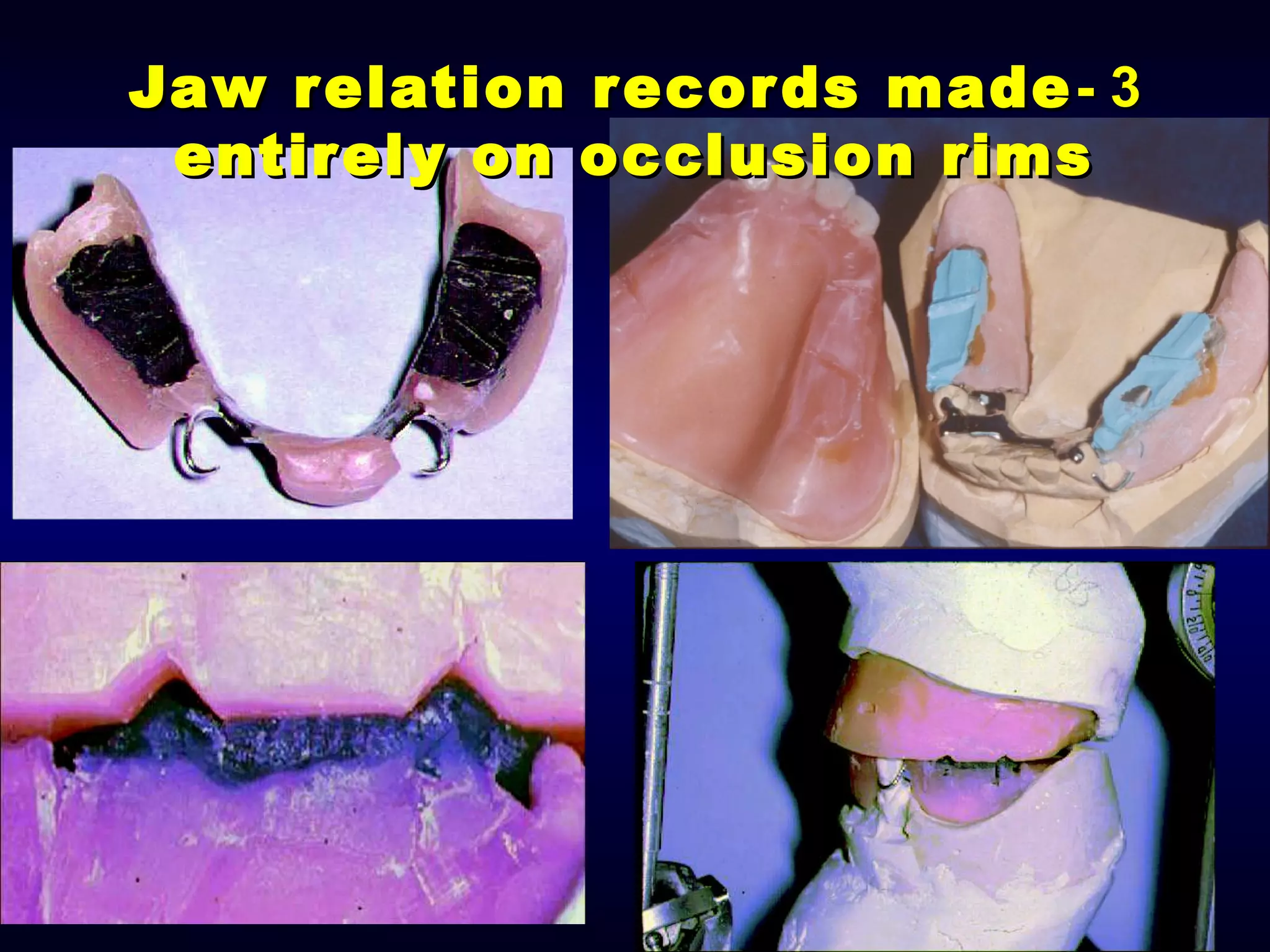 Occlusal Rim Inclinator 8- Occlusal Relationships for Removable Partial Dentures | PPT