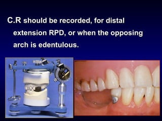 Occlusal Record Rpd 8- Occlusal Relationships for Removable Partial Dentures | PPT