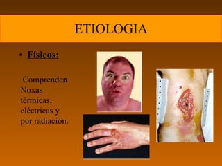 ETIOLOGIA
• Físicos:

 Comprenden
Noxas
térmicas,
eléctricas y
por radiación.
 