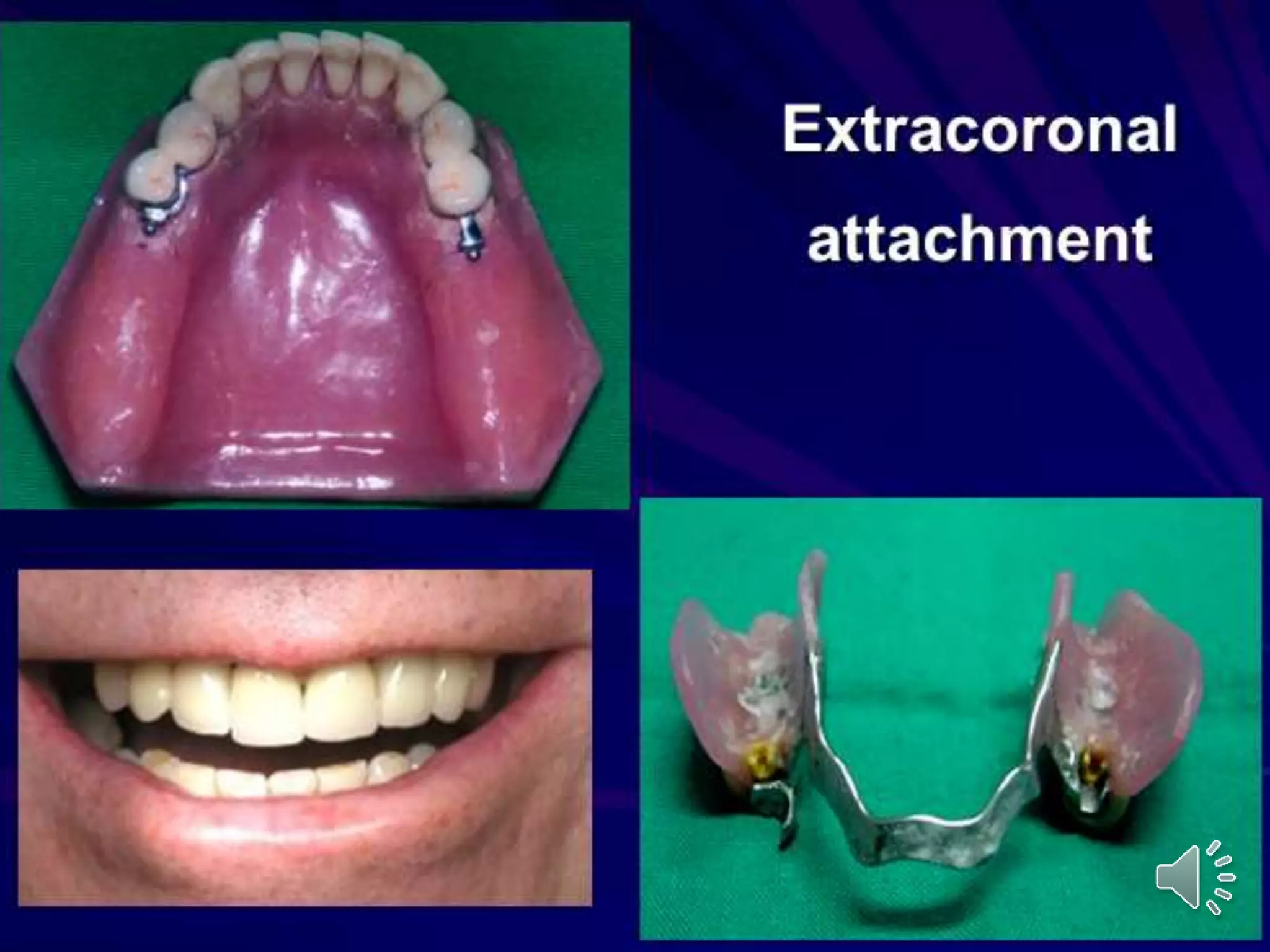 Direct Retainers of RPDs | PPT