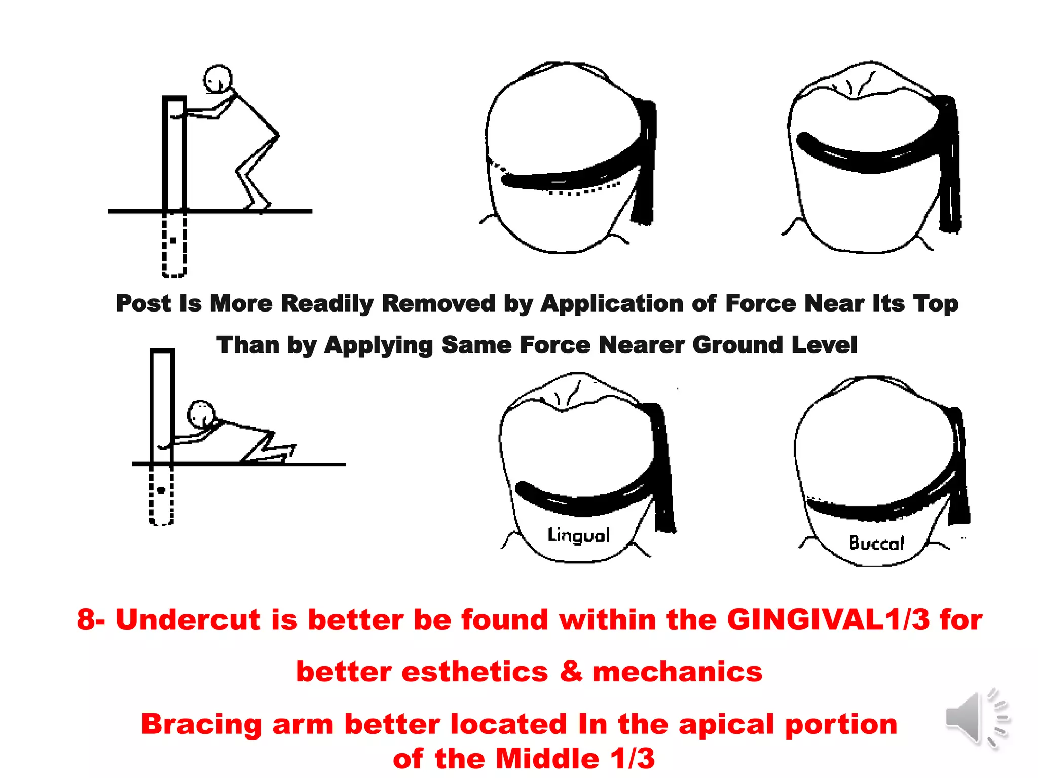 Direct Retainers of RPDs | PPT