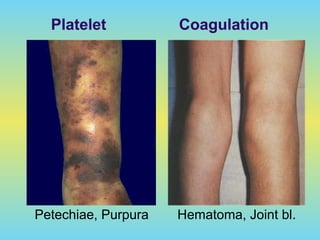 Platelet Coagulation
Petechiae, Purpura Hematoma, Joint bl.
 