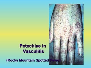 Petechiae inPetechiae in
VasculitisVasculitis
(Rocky Mountain Spotted Fever)(Rocky Mountain Spotted Fever)
 