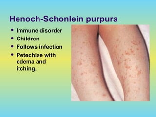 Henoch-Schonlein purpura
 Immune disorder
 Children
 Follows infection
 Petechiae with
edema and
itching.
 