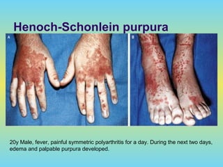 Henoch-Schonlein purpura
20y Male, fever, painful symmetric polyarthritis for a day. During the next two days,
edema and palpable purpura developed.
 