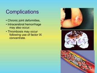 Complications
• Chronic joint deformities,
• Intracerebral hemorrhage
may also occur.
• Thrombosis may occur
following use of factor IX
concentrate.
 