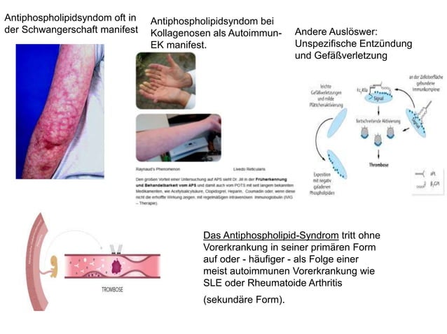 Kollagenose,Kollagenosen allgemein,Systemischer Lupus Erythematodes