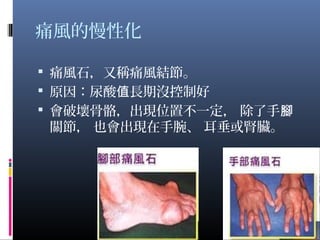 痛風的慢性化
 痛風石，又稱痛風結節。
 原因：尿酸 長期沒控制好值
 會破壞骨骼，出現位置不一定， 除了手腳
關節， 也會出現在手腕、 耳垂或腎臟。
12
 