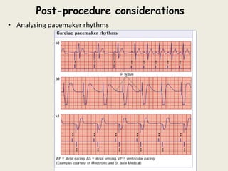Post-procedure considerations
• Analysing pacemaker rhythms
 