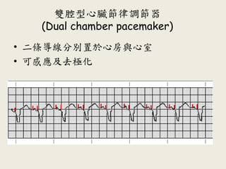 雙腔型心臟節律調節器
(Dual chamber pacemaker)
• 二條導線分別置於心房與心室
• 可感應及去極化
 