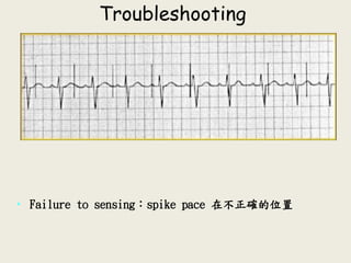 Troubleshooting
• Failure to sensing：spike pace 在不正確的位置
 