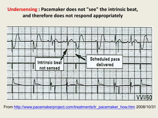 Undersensing : Pacemaker does not "see" the intrinsic beat,
and therefore does not respond appropriately
From http://www.pacemakerproject.com/treatments/tr_pacemaker_how.htm 2008/10/31
 