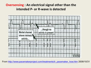 Oversensing : An electrical signal other than the
intended P- or R-wave is detected
From http://www.pacemakerproject.com/treatments/tr_pacemaker_how.htm 2008/10/31
 
