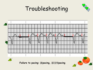 Troubleshooting
Failure to pacing: 該pacing, 卻沒有pacing
 
