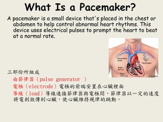 What Is a Pacemaker?
A pacemaker is a small device that's placed in the chest or
abdomen to help control abnormal heart rhythms. This
device uses electrical pulses to prompt the heart to beat
at a normal rate.
三部份所組成
由節律器（pulse generator ）
電極（electrode）電極的前端安置在心臟裡面
導線（lead）導線連接節律器與電極間，節律器以一定的速度
將電刺激傳到心臟，使心臟維持規律的跳動。
 