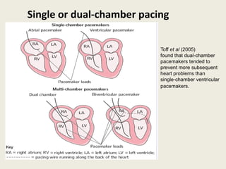 Single or dual-chamber pacing
Toff et al (2005)
found that dual-chamber
pacemakers tended to
prevent more subsequent
heart problems than
single-chamber ventricular
pacemakers.
 