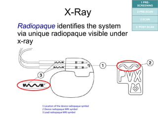 New Technology: 核磁共振相容節律器 - ”MRI Standard of Care for Pacemaker ...