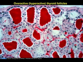 Overactive (hyperactive) thyroid follicles
Medical Histology atlas by Stanley L. Erlandsen and Jean E. MagneyAug 26, 2013 Umar Ahmad 60
 