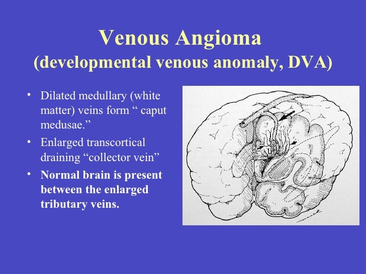 developmental venous anomaly