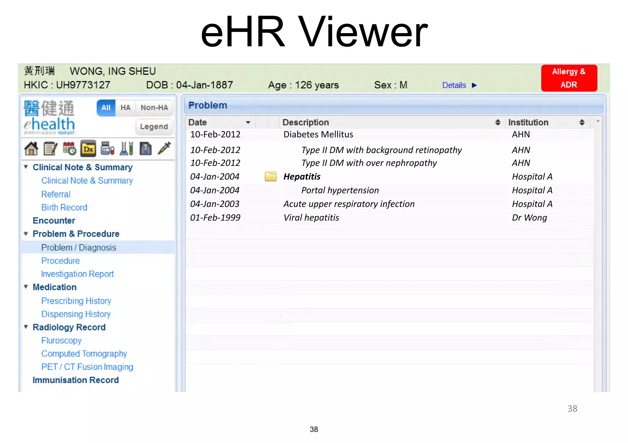 eHR Viewer 
10-­‐Feb-­‐2012 Diabetes Mellitus AHN 
10-­‐Feb-­‐2012 
Type 
II 
DM 
with 
background 
retinopathy AHN 
10-­‐Feb-­‐2012 
Type 
II 
DM 
with 
over 
nephropathy AHN 
04-­‐Jan-­‐2004 Hepatitis Hospital 
A 
04-­‐Jan-­‐2004 
Portal 
hypertension Hospital 
A 
04-­‐Jan-­‐2003 Acute 
upper 
respiratory 
infection Hospital 
A 
01-­‐Feb-­‐1999 Viral 
hepatitis Dr 
Wong 
38 
38 
 