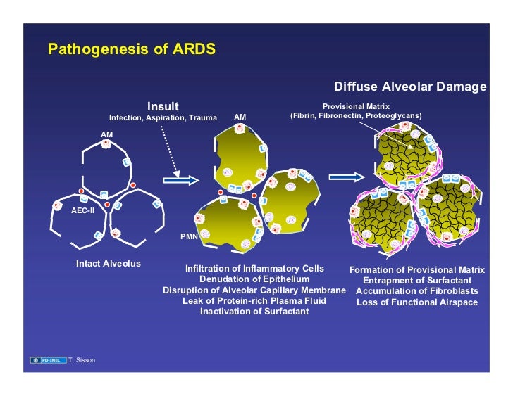 09.17.08(c): Acute Respiratory Distress Syndrome