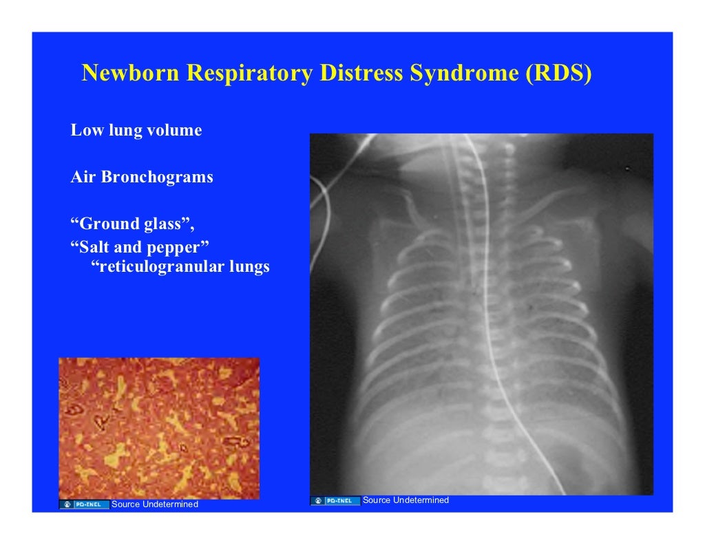 09.23.08 Newborn Respiratory Disease