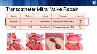 Transcatheter Edge-to-Edge Repair (TEER) for Primary Mitral Valve ...