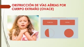 OBSTRUCCIÓN DE VÍAS AÉREAS POR
CUERPO EXTRAÑO (OVACE)
 