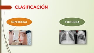 CLASIFICACIÓN
SUPERFICIAL PROFUNDA
 