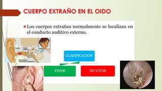 CUERPO EXTRAÑO EN EL OIDO
 