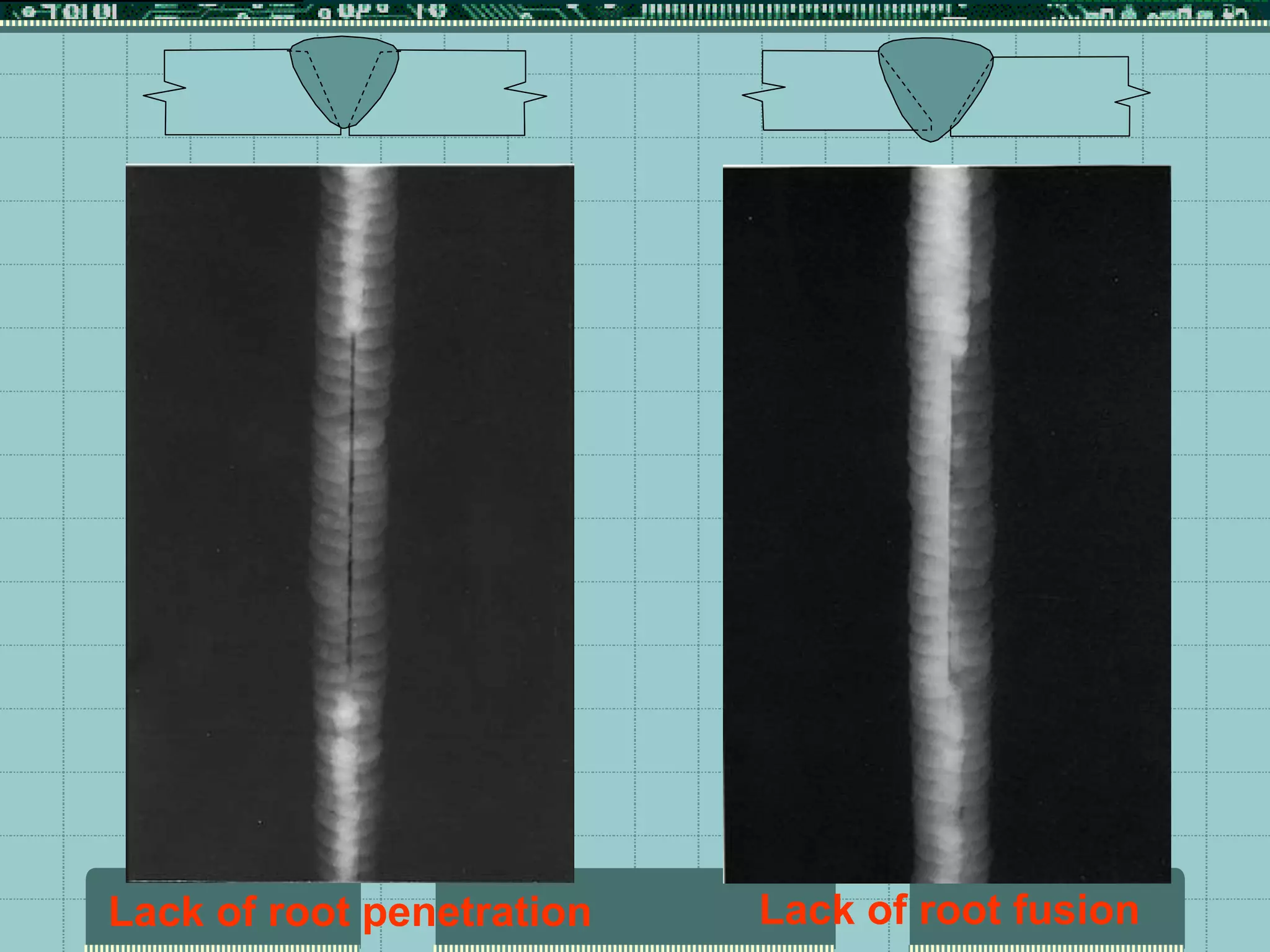 Lack of root fusion
Lack of root penetration
 