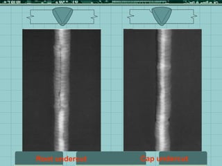 Cap undercut
Root undercut
 