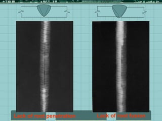 Lack of root fusion
Lack of root penetration
 