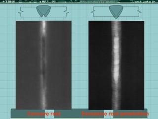 Concave root Excessive root penetration
 