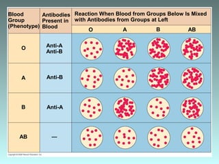 Antibodies
Present in
Blood
Anti-A
Anti-B
Reaction When Blood from Groups Below Is Mixed
with Antibodies from Groups at Left
Anti-B
O A B AB
—
Anti-A
Blood
Group
(Phenotype)
O
A
B
AB
 