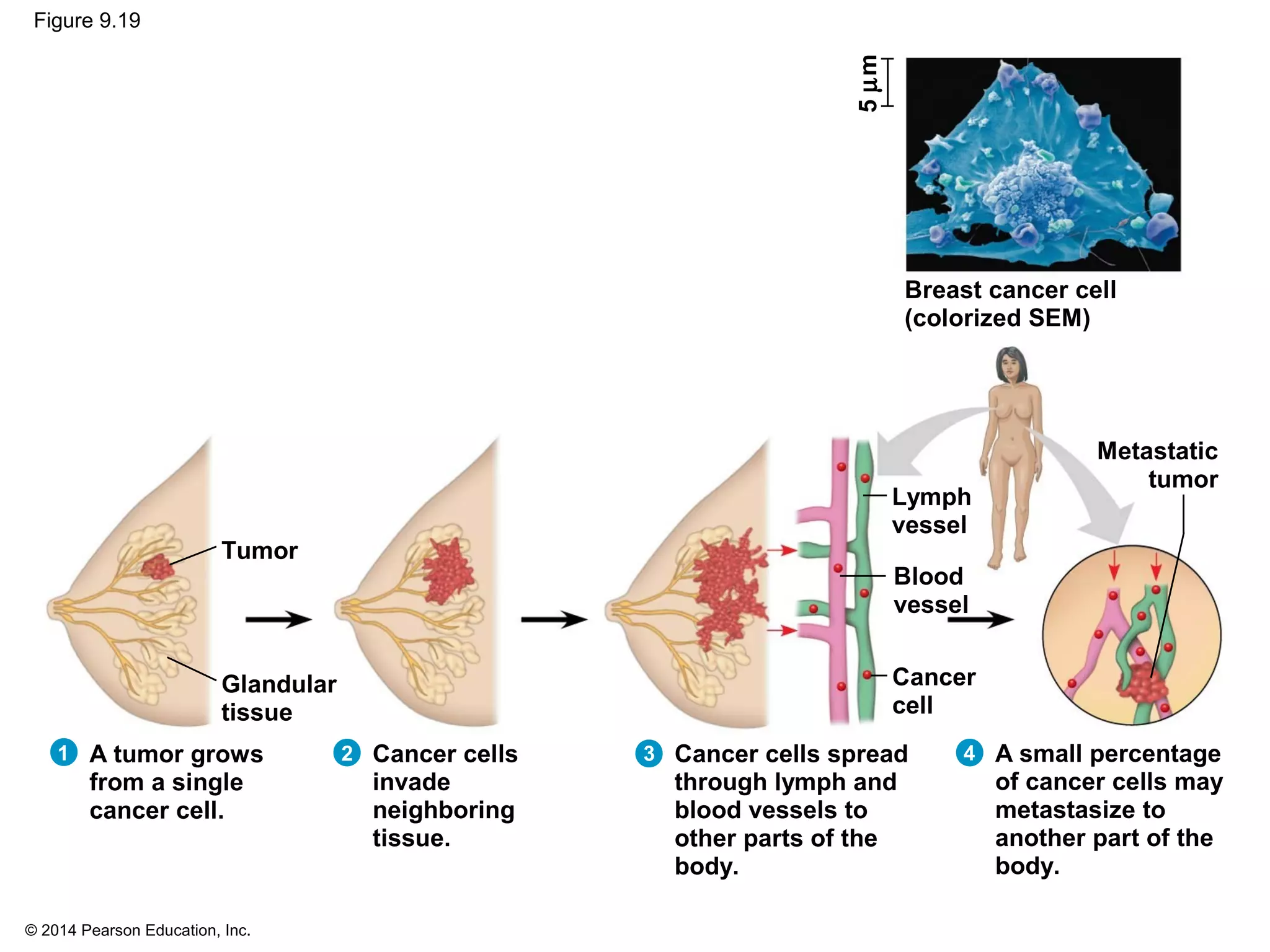 © 2014 Pearson Education, Inc.
Figure 9.19
1 A tumor grows
from a single
cancer cell.
Cancer cells
invade
neighboring
tissue.
Cancer cells spread
through lymph and
blood vessels to
other parts of the
body.
A small percentage
of cancer cells may
metastasize to
another part of the
body.
Breast cancer cell
(colorized SEM)
Lymph
vessel
Blood
vessel
Cancer
cell
Metastatic
tumor
Glandular
tissue
Tumor
5µm
2 3 4
 