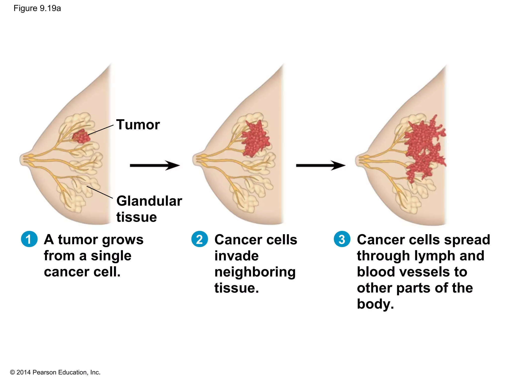 © 2014 Pearson Education, Inc.
Figure 9.19a
A tumor grows
from a single
cancer cell.
Cancer cells
invade
neighboring
tissue.
Cancer cells spread
through lymph and
blood vessels to
other parts of the
body.
Glandular
tissue
Tumor
1 2 3
 