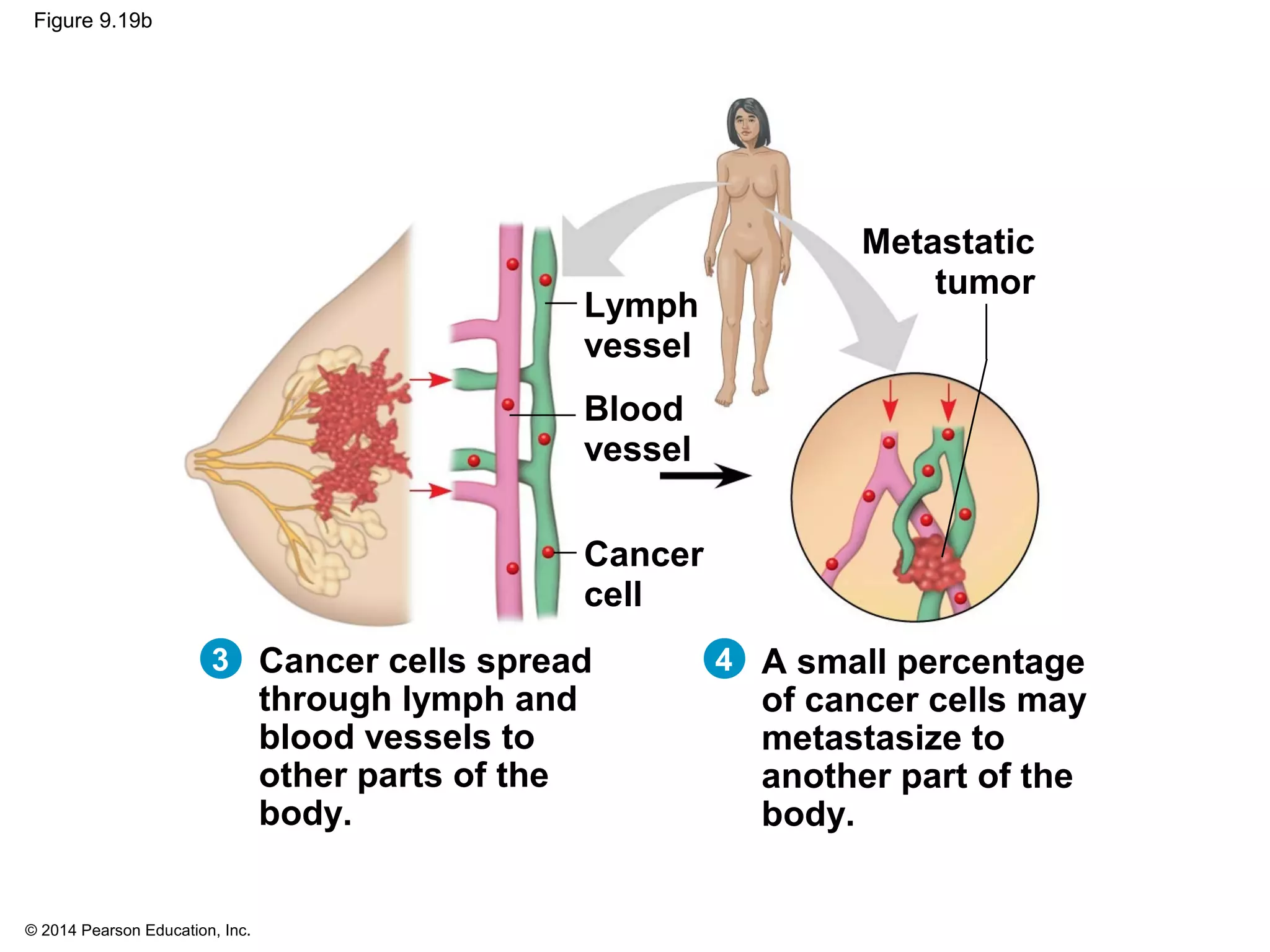 © 2014 Pearson Education, Inc.
Figure 9.19b
43 Cancer cells spread
through lymph and
blood vessels to
other parts of the
body.
A small percentage
of cancer cells may
metastasize to
another part of the
body.
Lymph
vessel
Blood
vessel
Cancer
cell
Metastatic
tumor
 