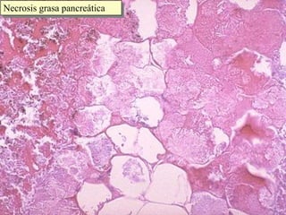 Necrosis grasa pancreática