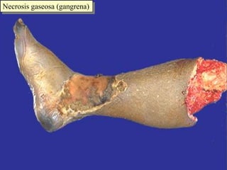 Necrosis gaseosa (gangrena) 