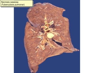 Necrosis caseosa (Tuberculosis pulmonar)