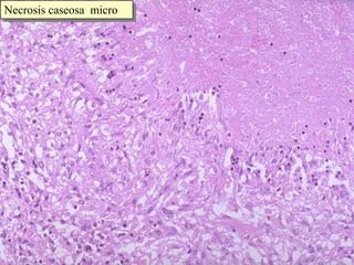 Necrosis caseosa  micro