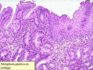 Metaplasia gástrica en esófago