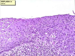 DISPLASIA de cérvix