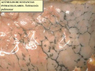 ACÚMULOS DE SUSTANCIAS INTRACELULARES:Antracosis pulmonar