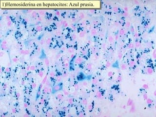 1)Hemosiderina en hepatocitos: Azul prusia.
