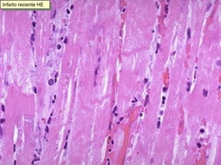 Infarto reciente HE