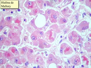 Hialina de Mallory