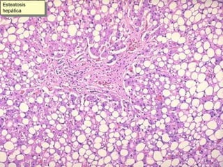 Esteatosis hepática